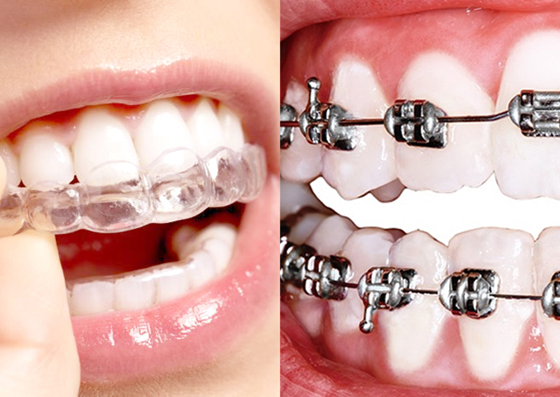 Ortodoncia Brackets Y Alineadores Ideal Dental