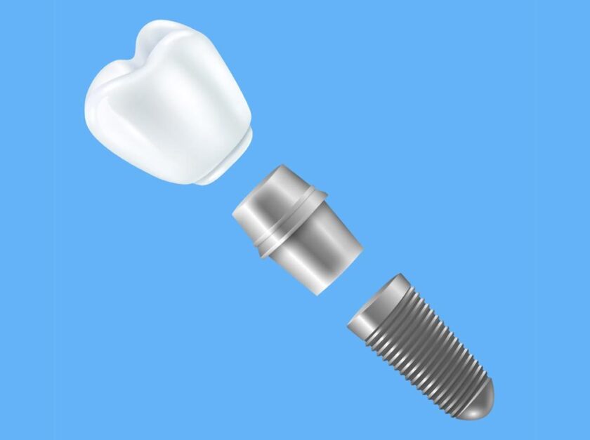 Screw dental implant Straumann