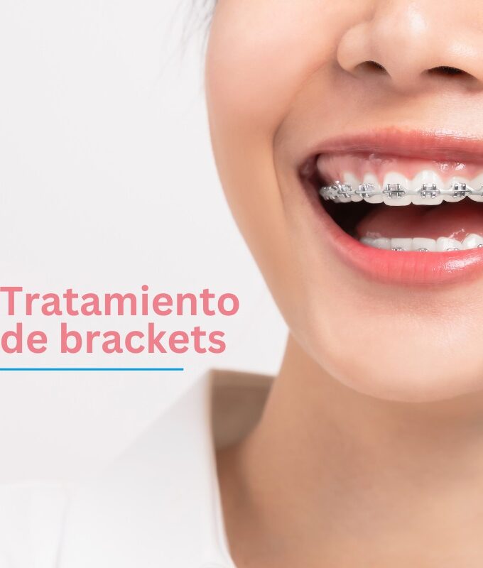 Brackets Treatment