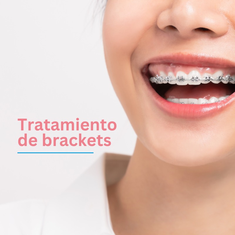 Tratamiento de Brackets