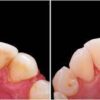 Deep cleaning 4 quadrants - Image 2