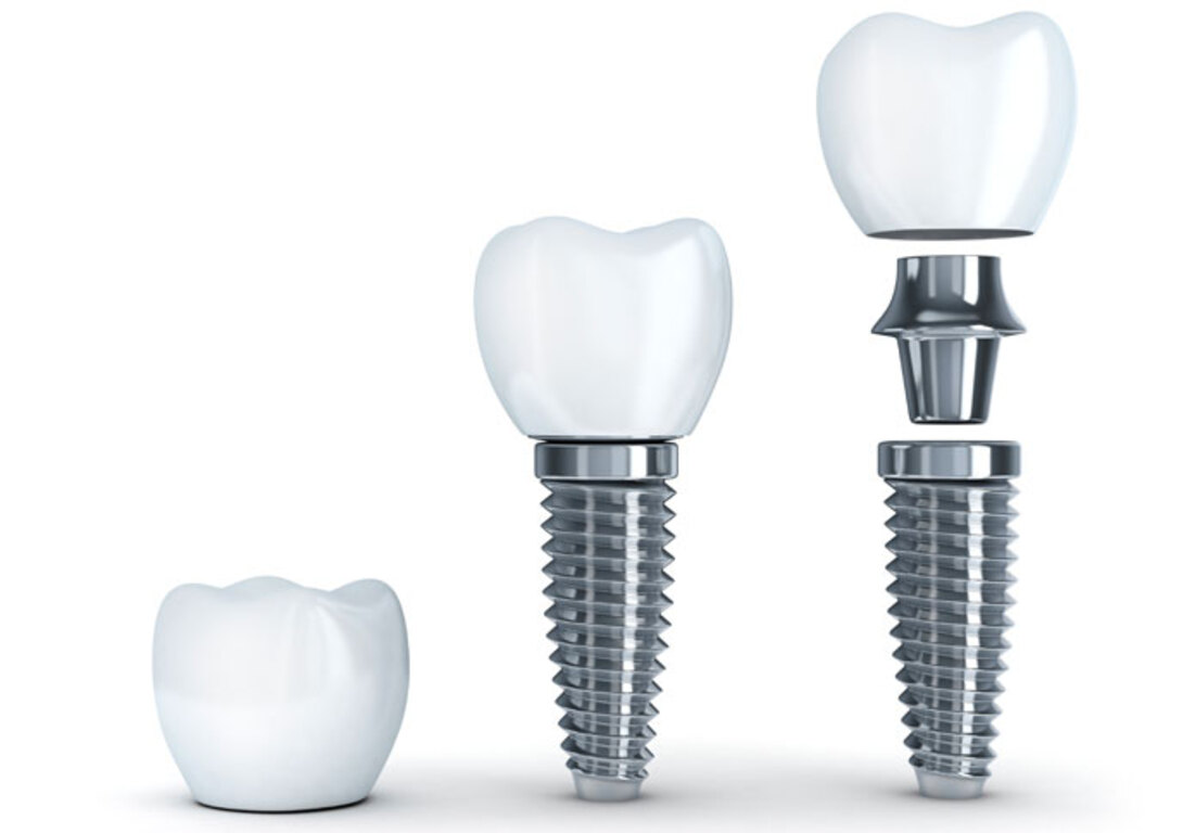 Fuente: https://polydentia.es/blog/preguntas-frecuentes-sobre-implantes-dentales/